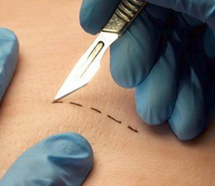 Planning the Orientation of Skin Incisions